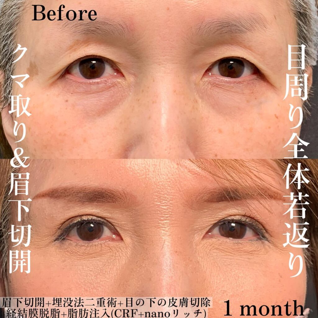 eクリニック新宿院の経血膜脱脂と脂肪注入と埋没法と眉下切開の症例写真(4)