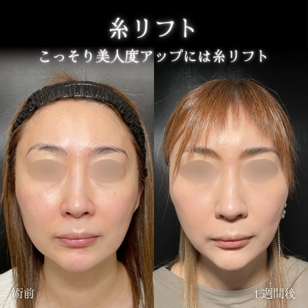 糸リフトの症例写真 (5)