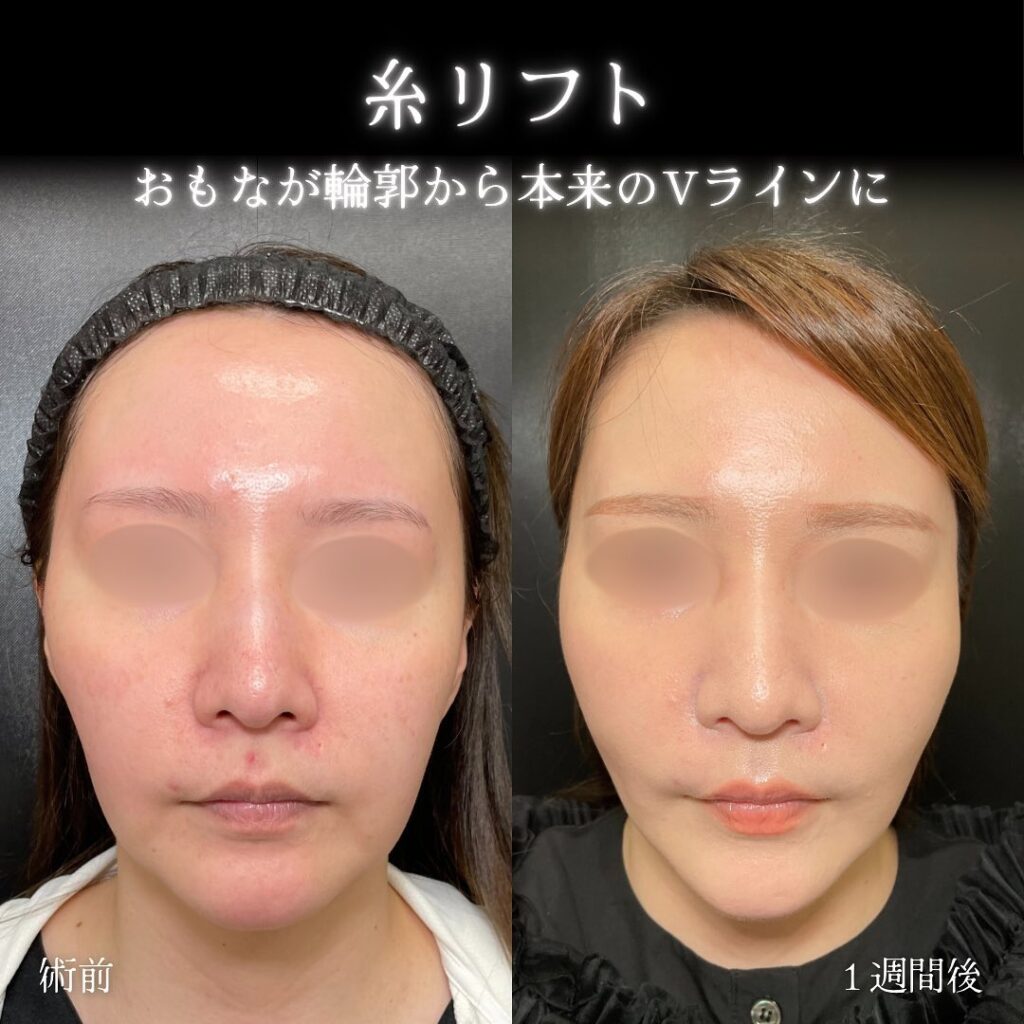糸リフトの症例写真 (2)