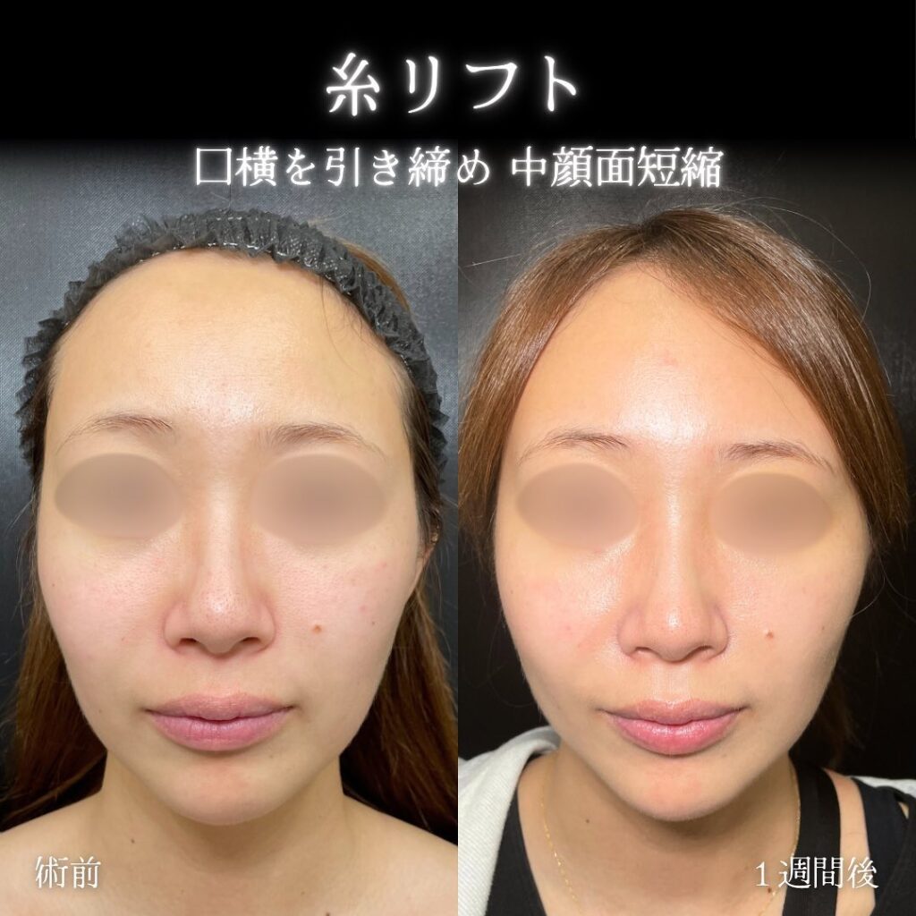 糸リフトの症例写真 (1)
