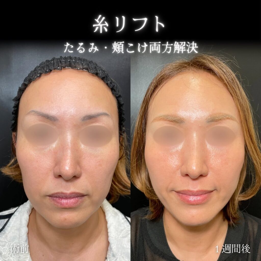 糸リフトの症例写真 (4)