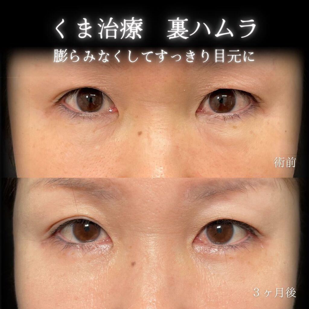 新宿院の裏ハムラの症例写真(6)