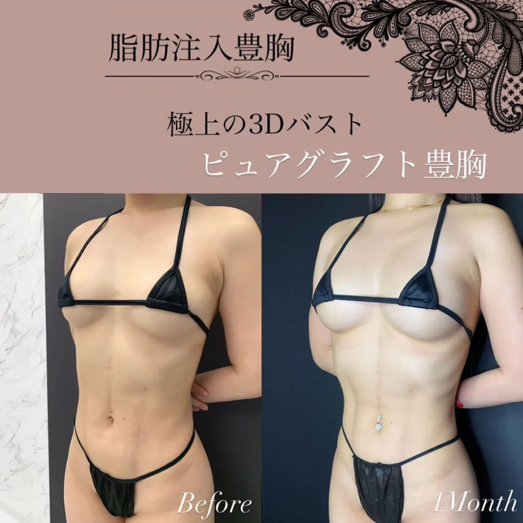 ピュアグラフトを受けた女性の症例写真