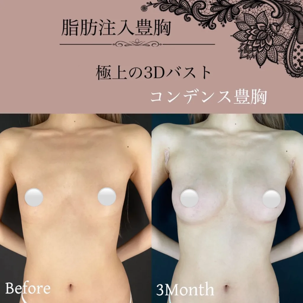 コンデンス豊胸の術前と３か月後の症例写真