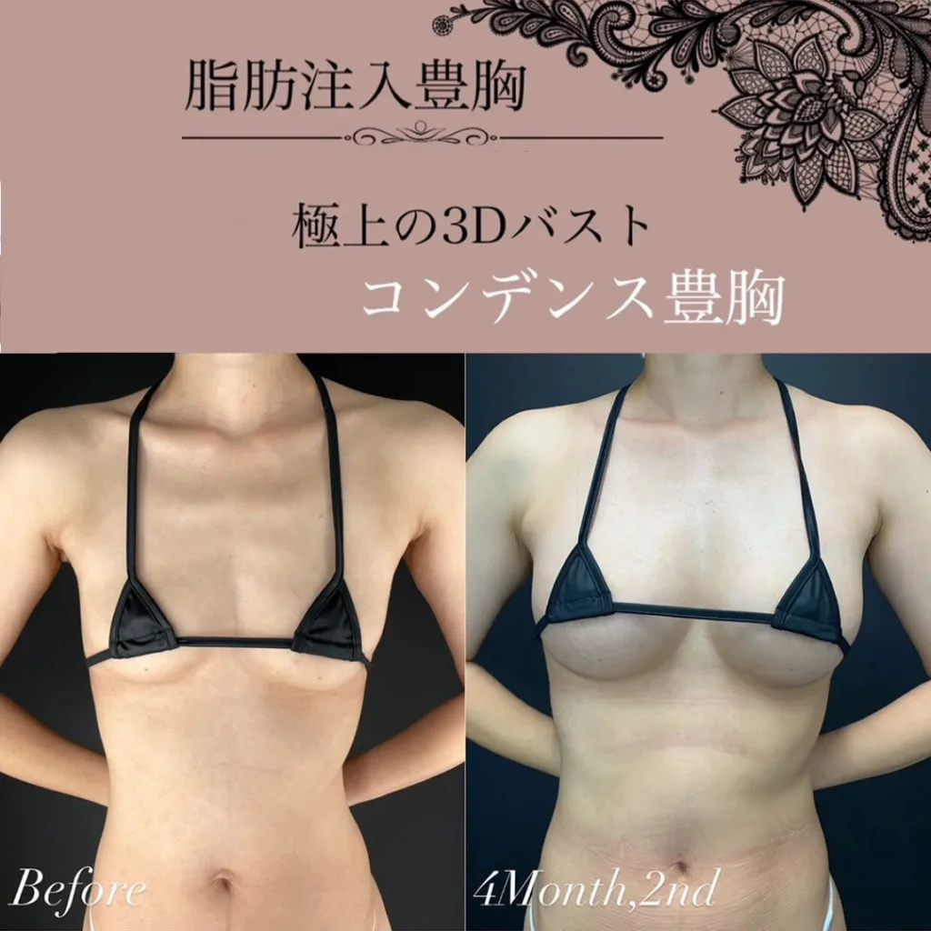 コンデンス豊胸を受けた女性の術前と4か月後の症例写真