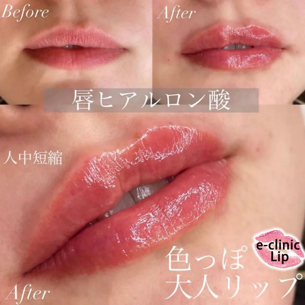 唇のヒアルロン酸と人中短縮の症例写真