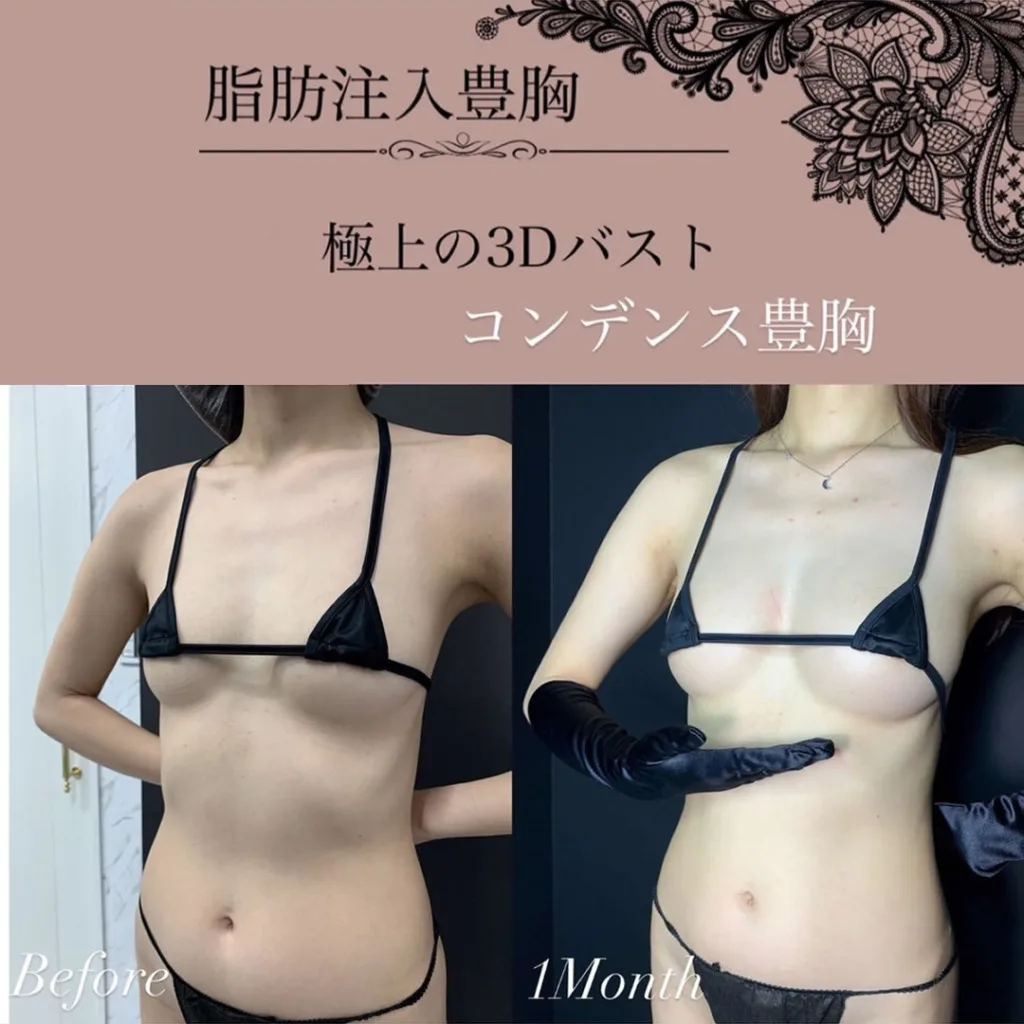 コンデンス豊胸を受けた女の症例写真