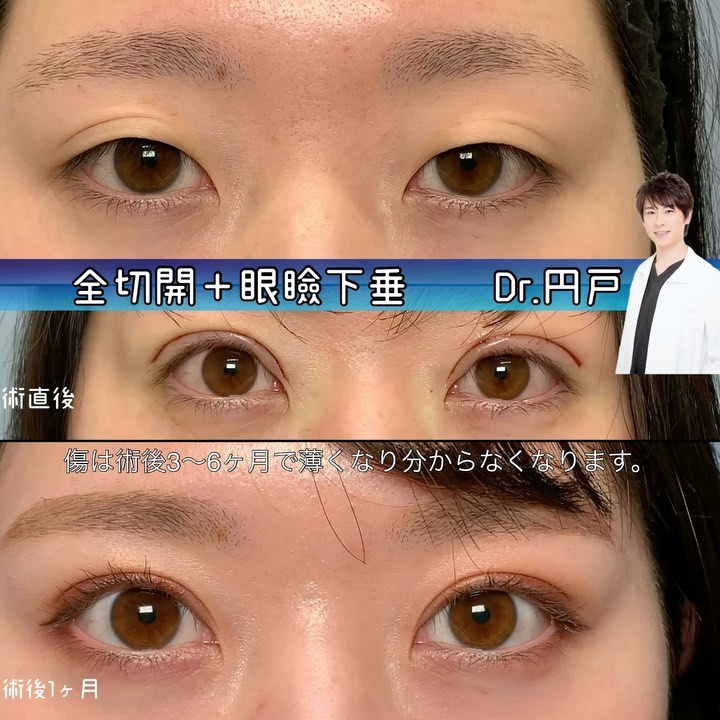 全切開と眼瞼下垂の症例写真 (7)