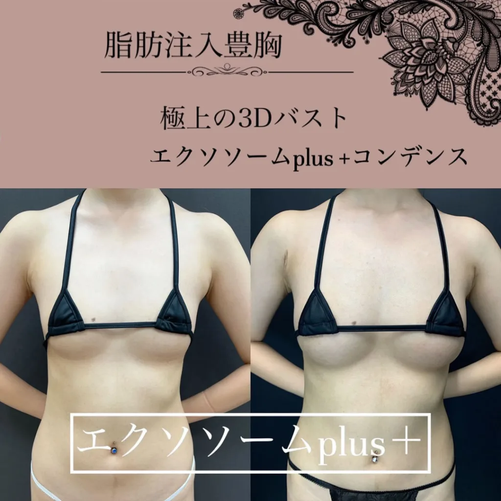 エクソソームplusとコンデンス豊胸の症例写真