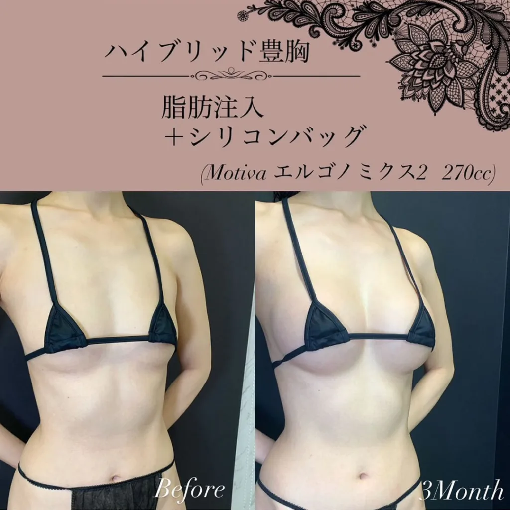 脂肪注入とモティバの症例写真