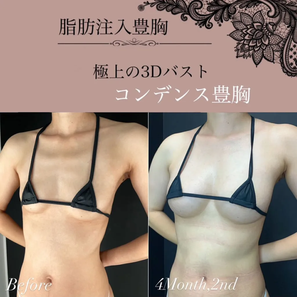 コンデンス豊胸の症例写真