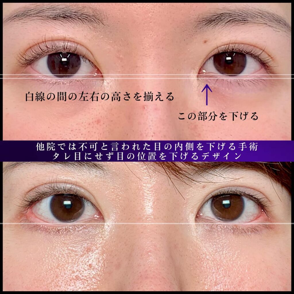 タレ目形成と目尻靭帯移動の症例写真 (3)