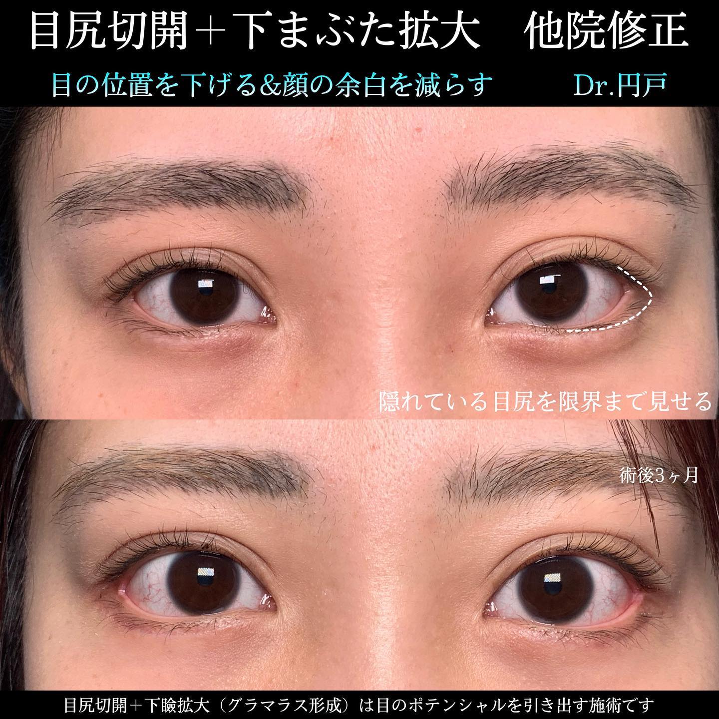 目尻切開とタレ目形成の他院修正の症例写真 (2)