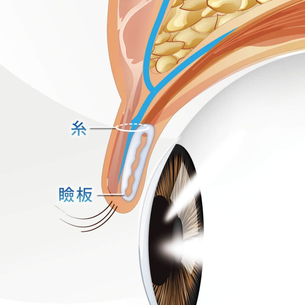 瞼板法の図解