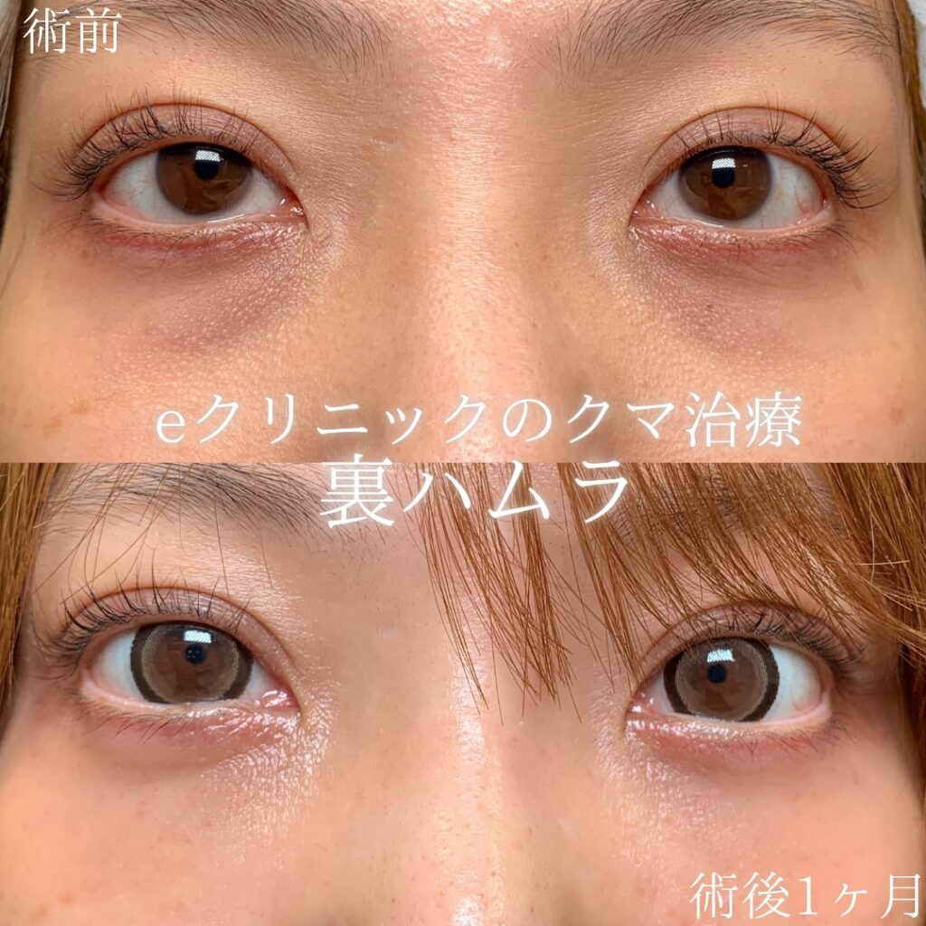 新宿院の裏ハムラの症例写真(1)