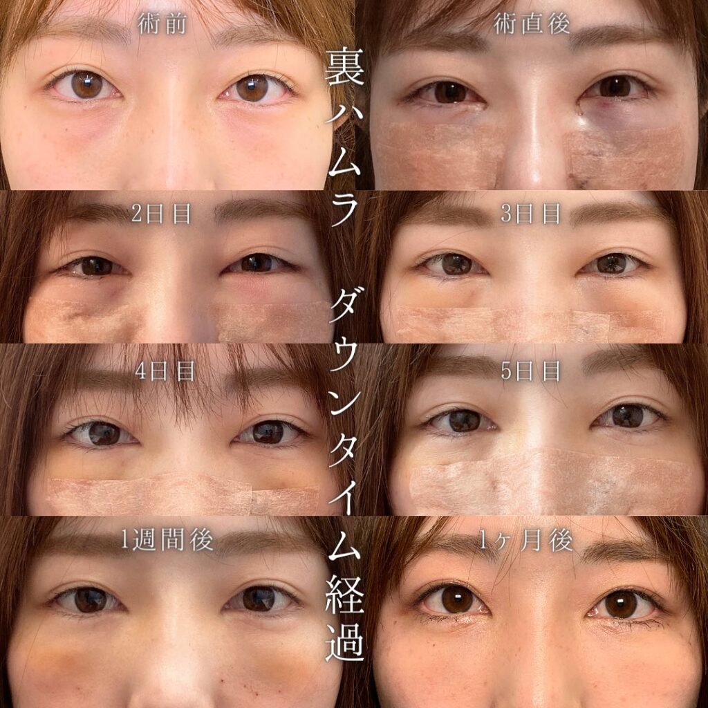 新宿院の裏ハムラの症例の経過写真