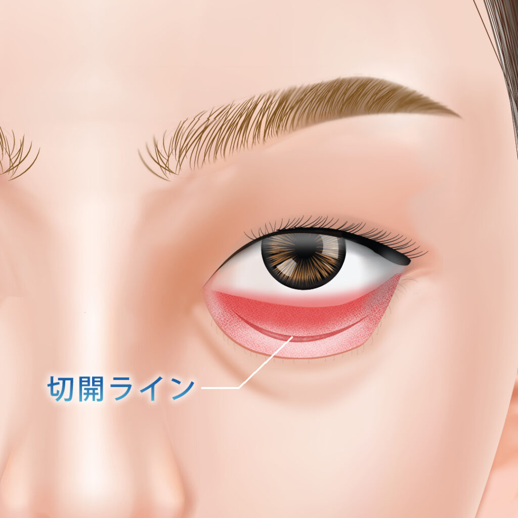経血膜脱脂の切開ライン