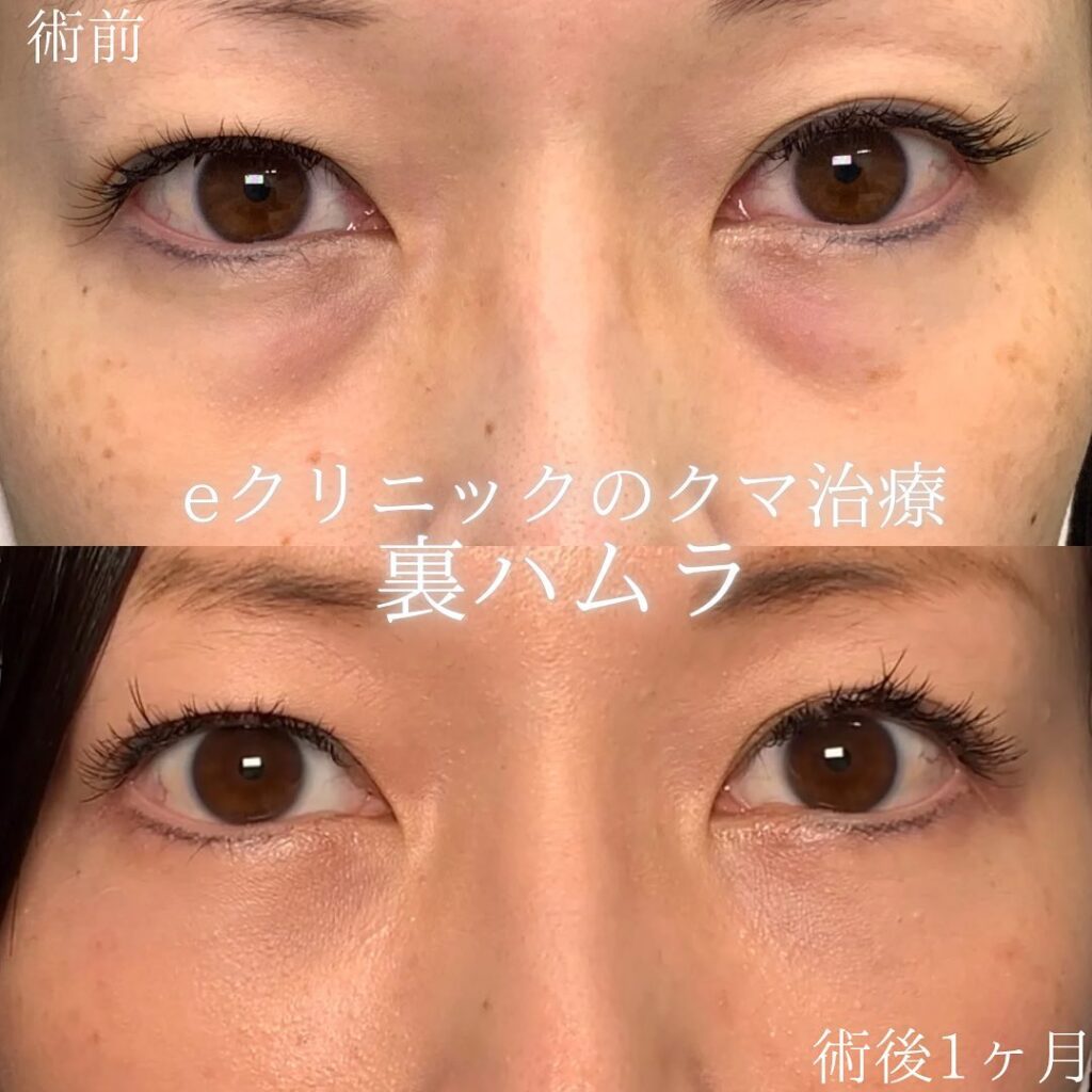 新宿院の裏ハムラの症例写真(3)