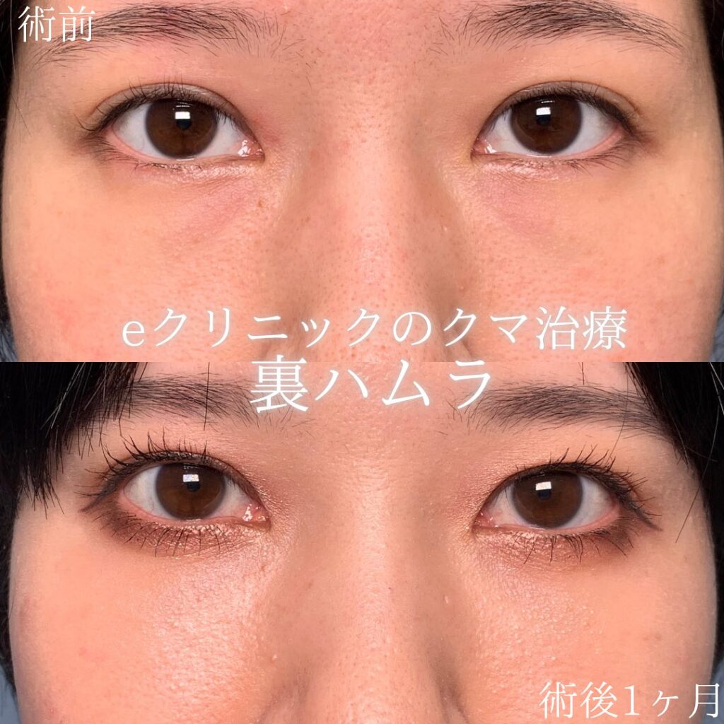 新宿院の裏ハムラの症例写真(2)