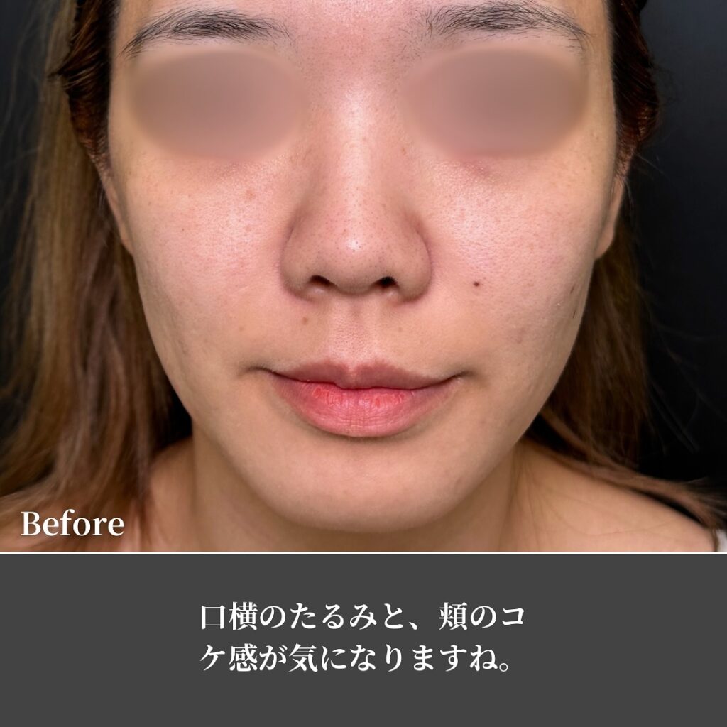 糸リフトの症例写真 (20)