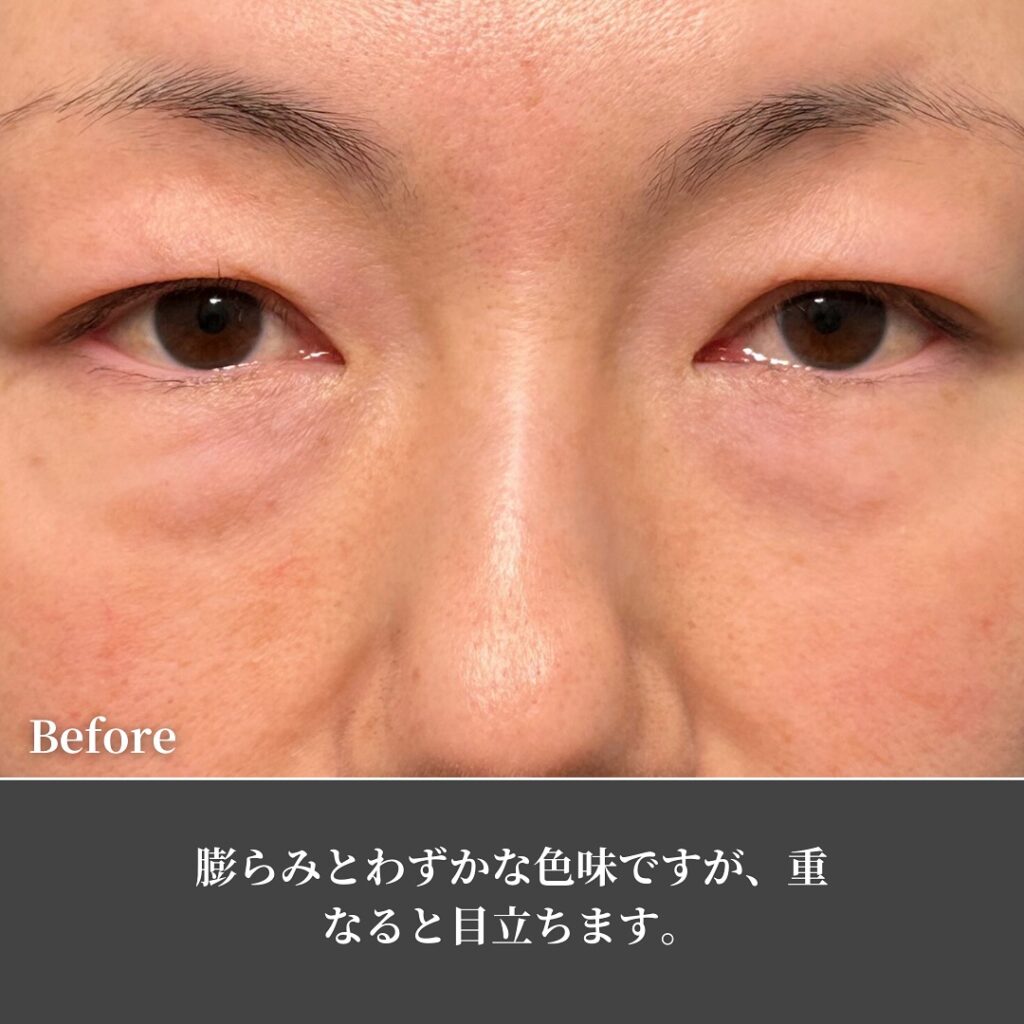 裏ハムラ法とナノリッチの症例写真 (14)