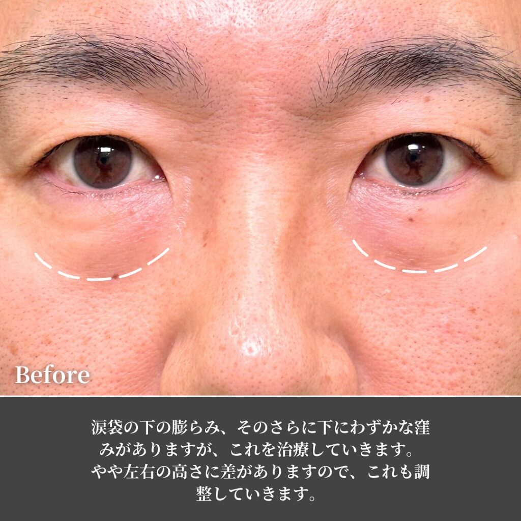 裏ハムラとナノリッチの症例写真 (8)