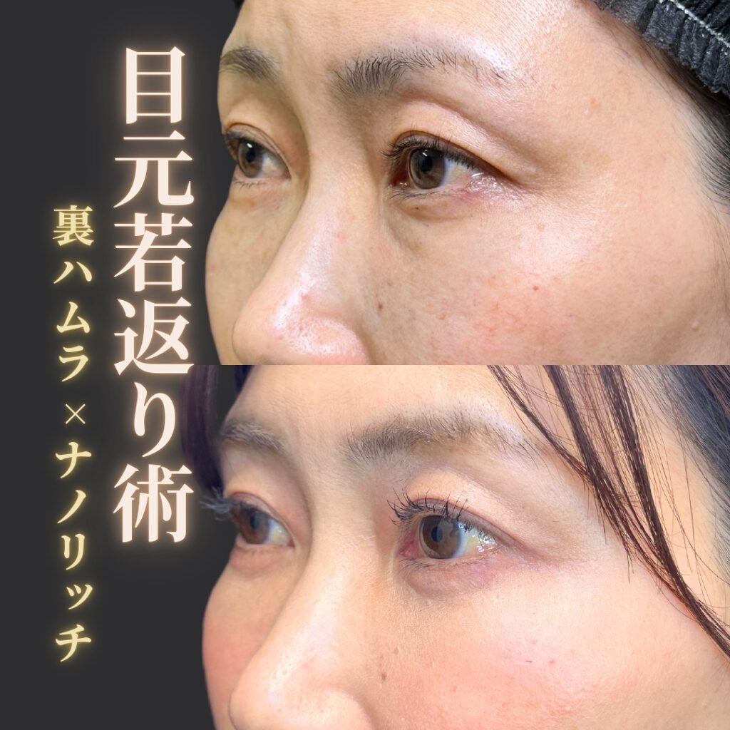 裏ハムラ法とナノリッチの症例写真 (7)