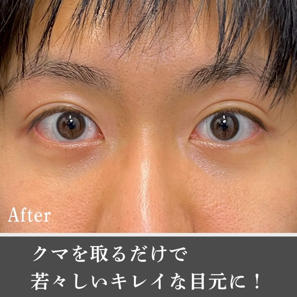 脱脂と脂肪注入 の男性の症例写真 (4)