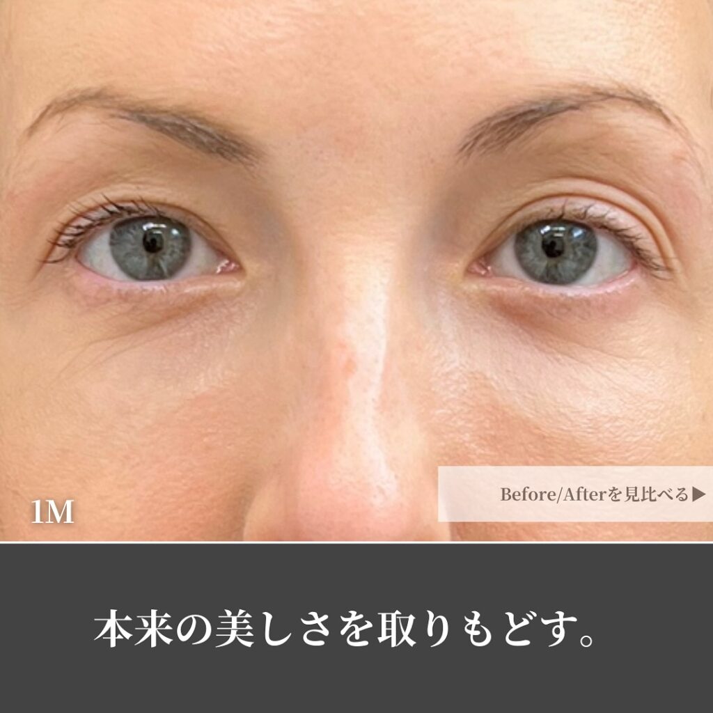 脱脂と脂肪注入の症例写真 (33)