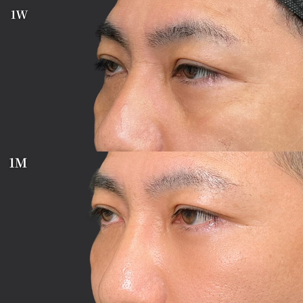 裏ハムラ法の症例写真 (58)