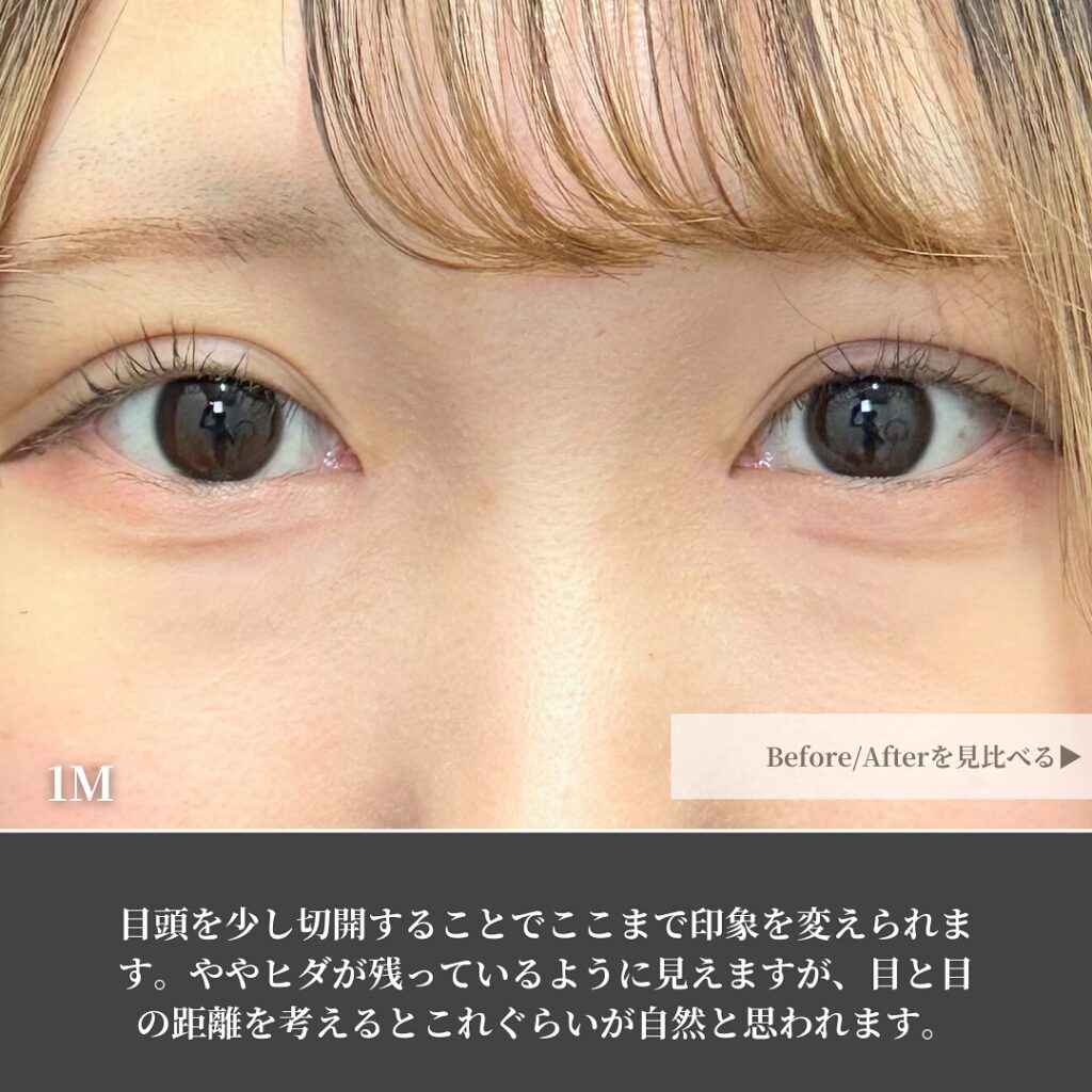 自然癒着法と目頭切開の症例写真 (9)