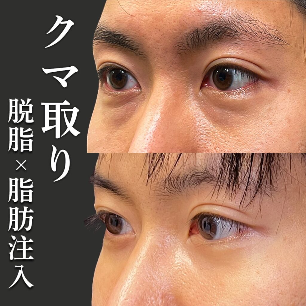 脱脂と脂肪注入 の男性の症例写真 (1)