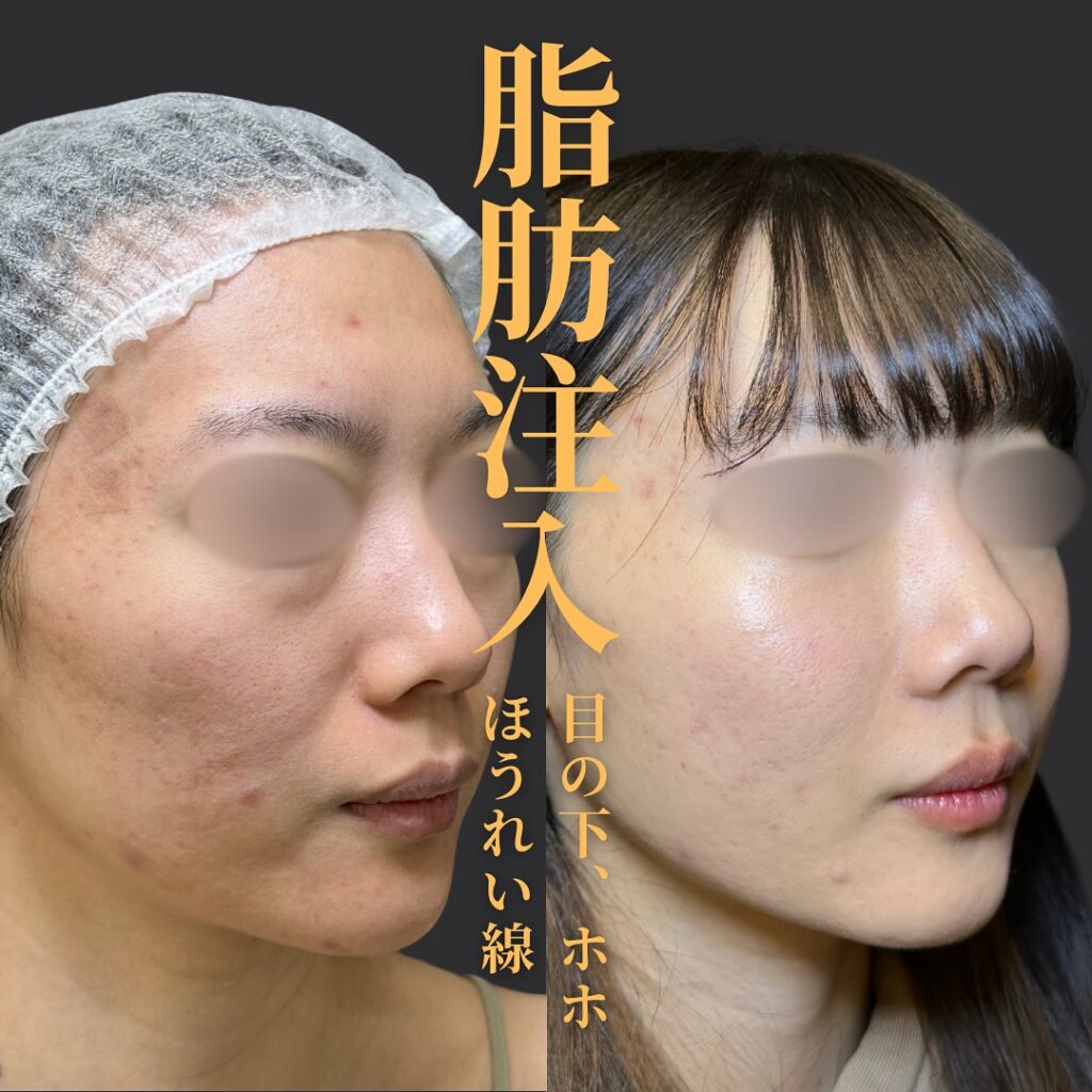 脂肪注入の症例写真 (8)