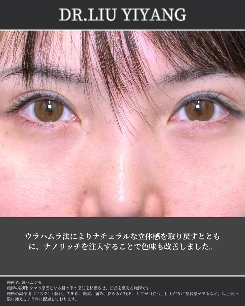 裏ハムラ法とナノリッチの症例写真 (32)