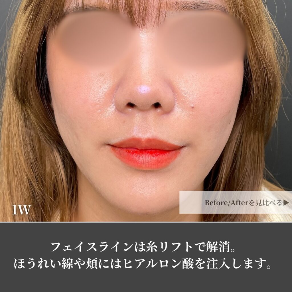 糸リフトの症例写真 (19)