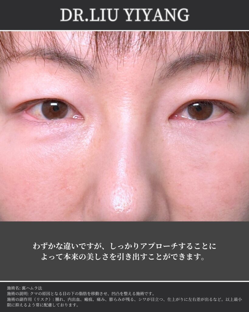 裏ハムラ法とナノリッチの症例写真 (28)