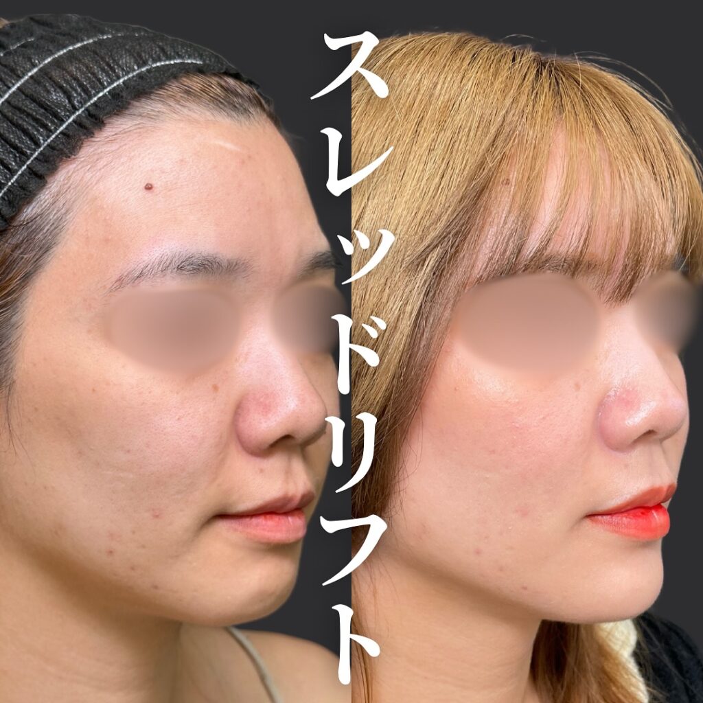 糸リフトの症例写真 (18)