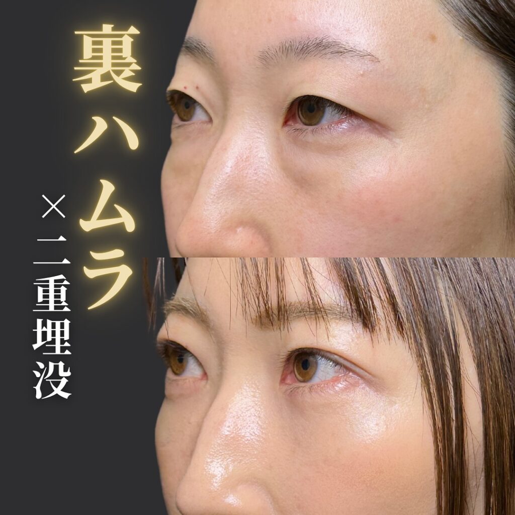 裏ハムラ法と埋没法の症例写真 (5)