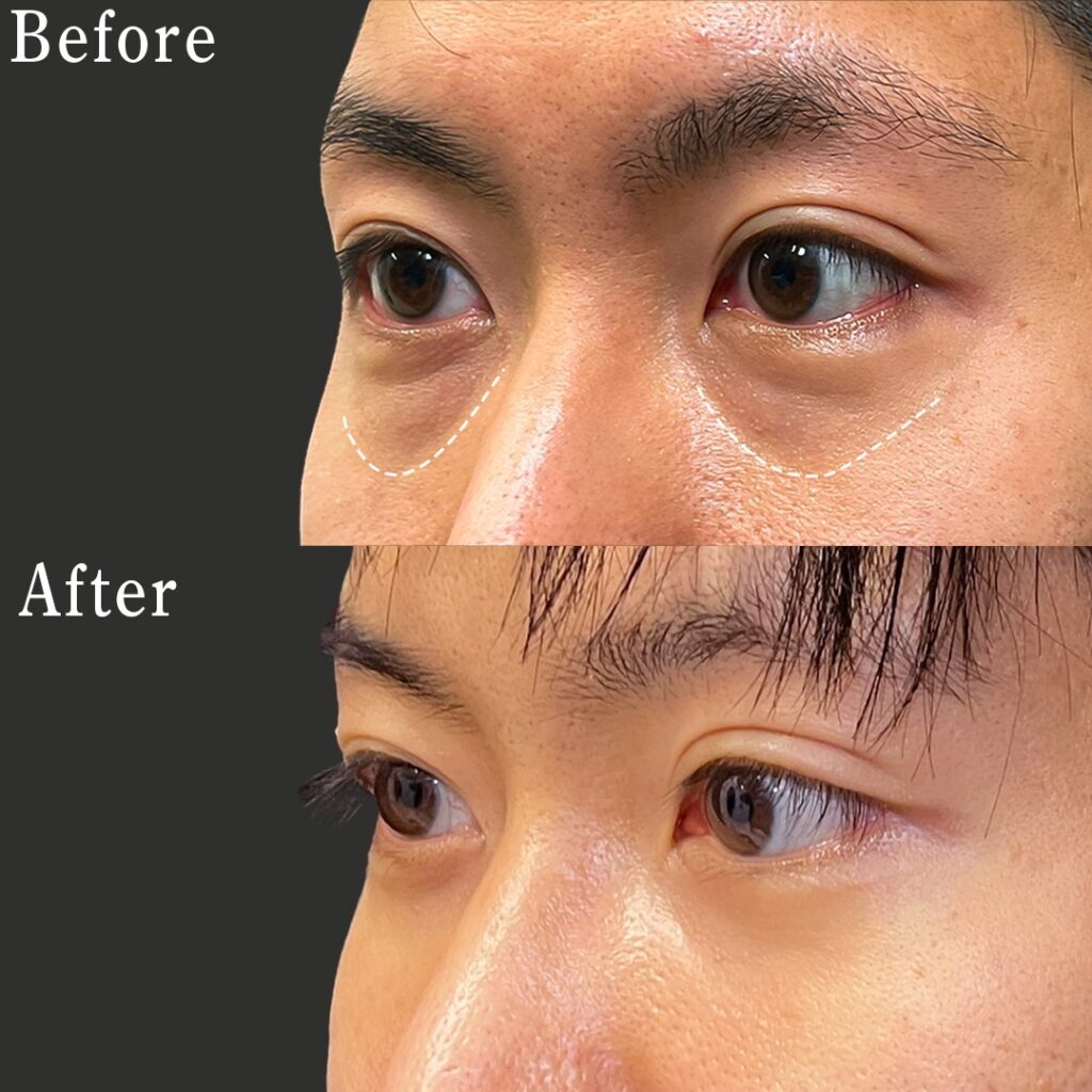脱脂と脂肪注入 の男性の症例写真 (3)