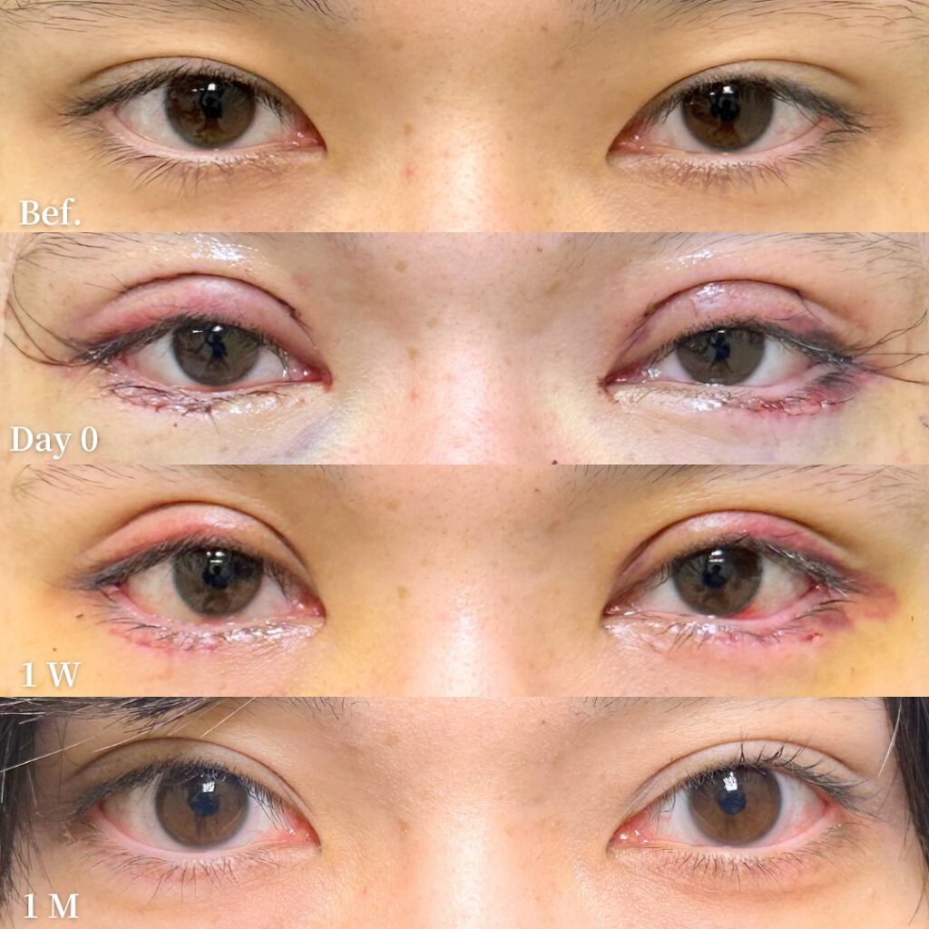 全切開とタレ目形成と目尻切開の症例写真 (1)