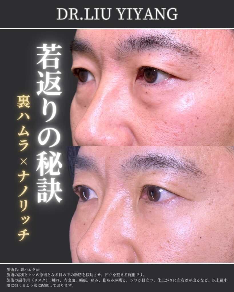 裏ハムラ法とナノリッチの症例写真 (21)