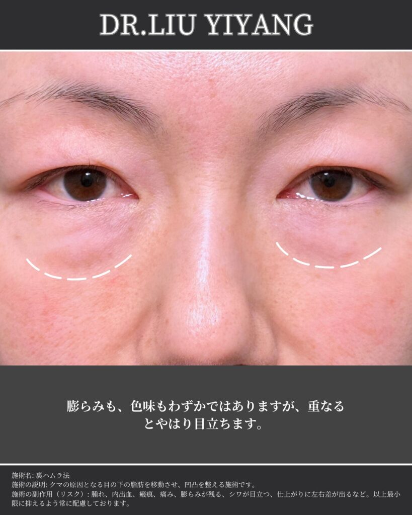 裏ハムラ法とナノリッチの症例写真 (29)