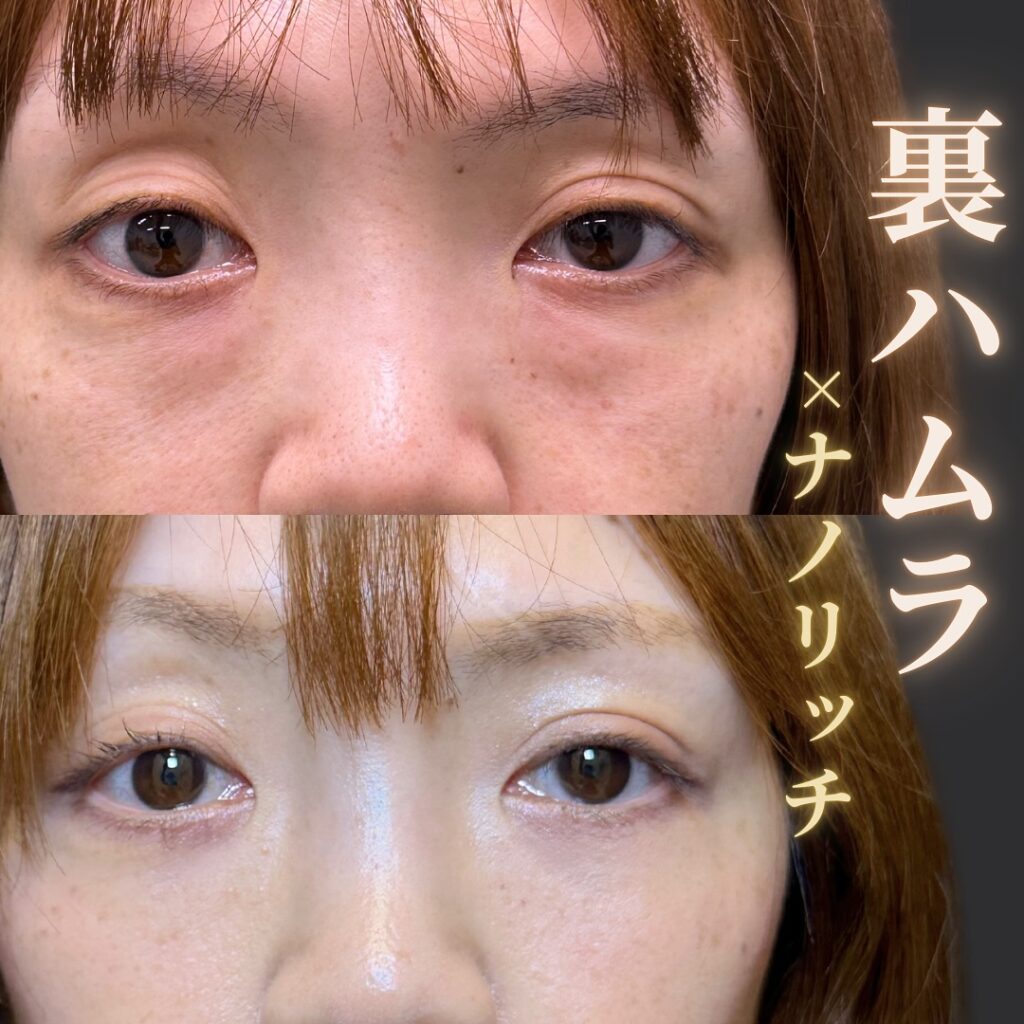 裏ハムラとナノリッチの症例写真 (1)
