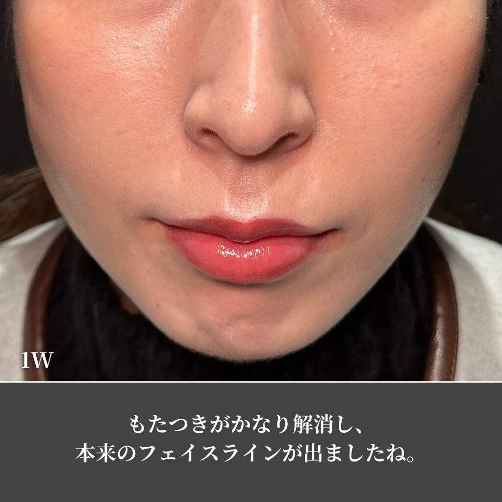 糸リフトの症例写真 (22)