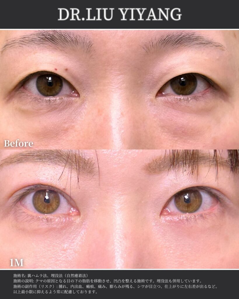 裏ハムラ法と自然癒着法の症例 (2)