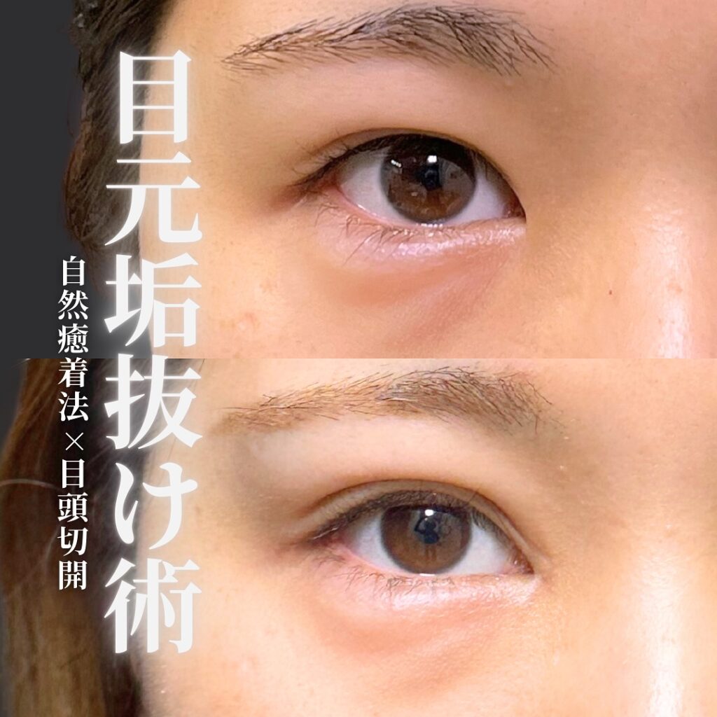 自然癒着法と目頭切開の症例 (2)