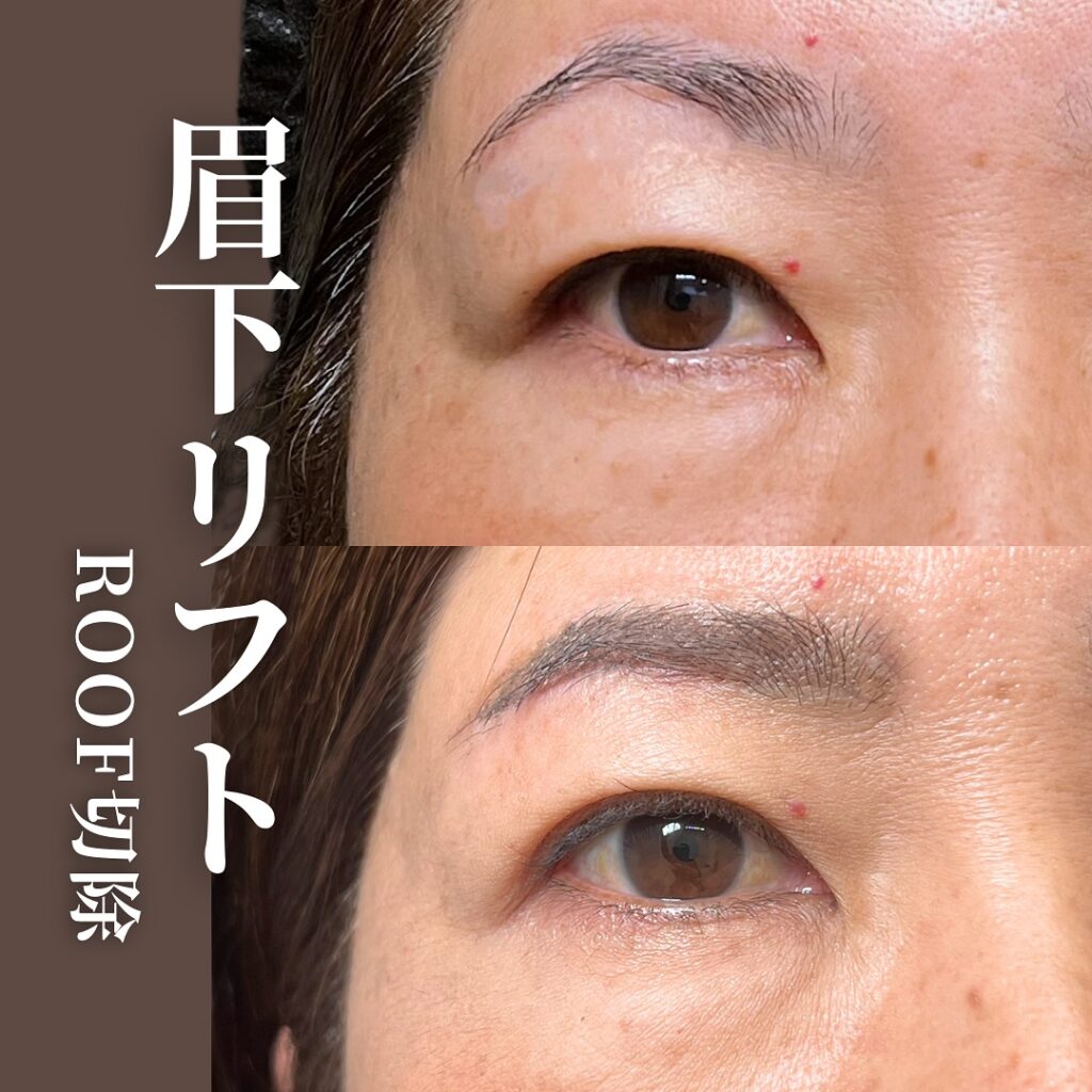 眉下切開の症例写真 (4)