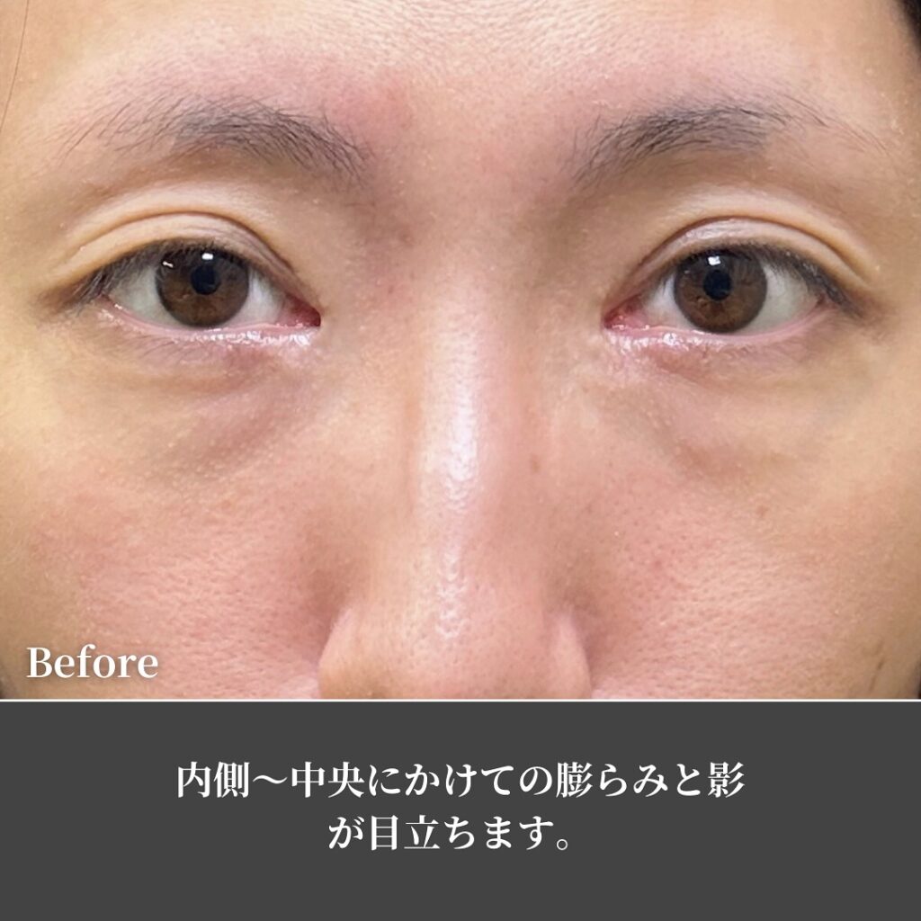 脱脂と脂肪注入でクマを改善した男性の症例写真 (4)