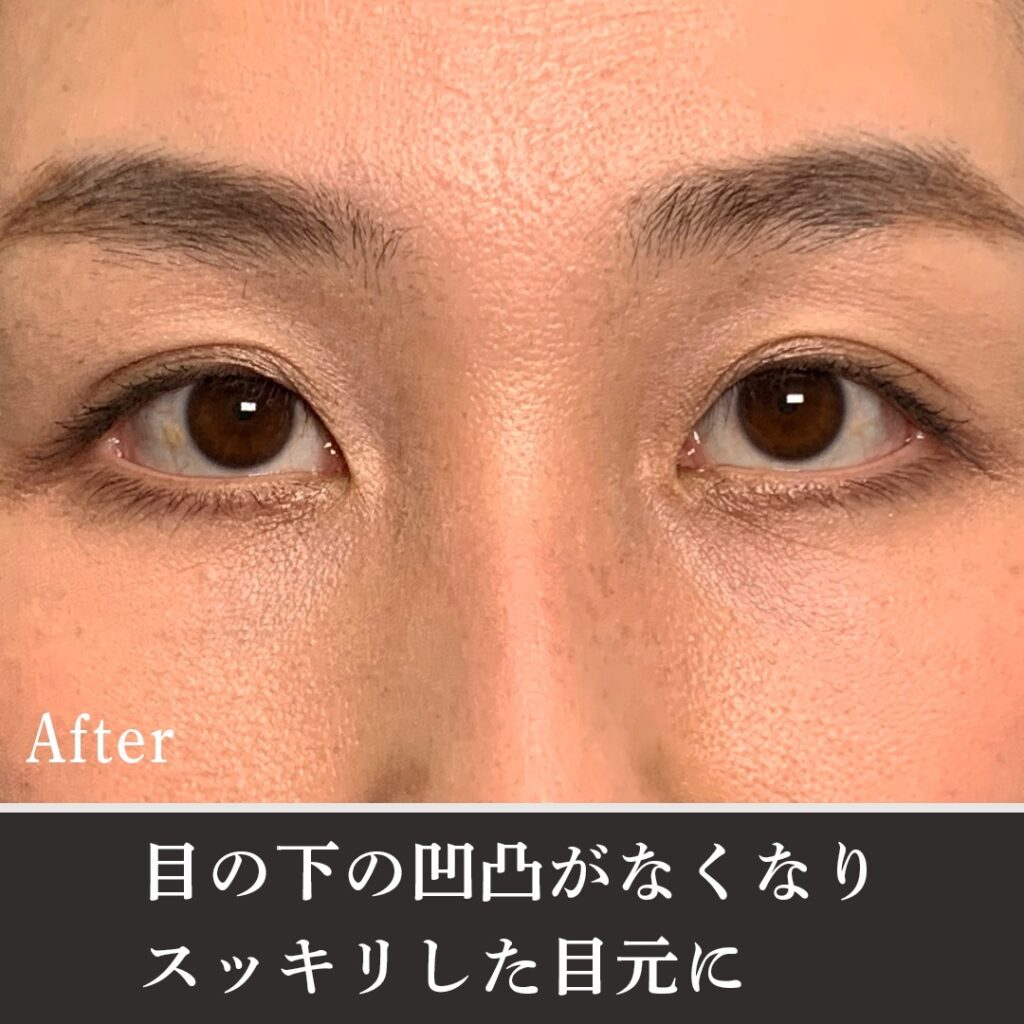 脱脂と脂肪注入の症例写真 (17)