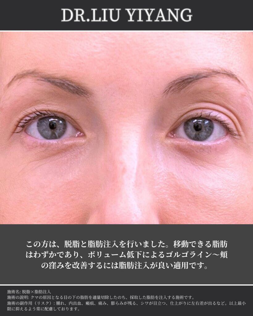 脱脂と脂肪注入の症例写真 (43)